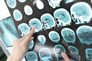 Brain Injury - Young and Nichols - Central Valley Car Crash Lawyers